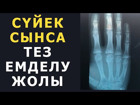 Видео: СЫНҒАН СҮЙЕКТІҢ ОРНЫН ҮЙ ЖАҒДАЙЫНДА ҚАЛАЙ ЕМДЕЙМІЗ, Сүйек сынса не істейміз, Керек арнасы