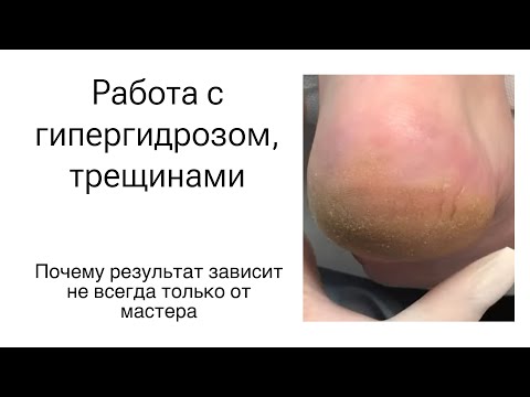 Видео: Результат педикюра, не всегда зависит от мастера