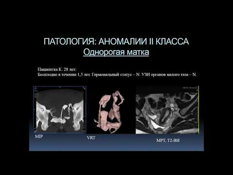 Видео: Богданова Е.О.«КТ- гистеросальпингография в диагностике причин бесплодия»
