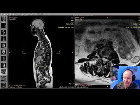 Видео: Воспаление позвонков по Модик. Разрушение тела позвонка