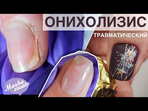 Видео: Травматический ОНИХОЛИЗИС: 3 вида. Что делать при отслоении ногтя? Новогодний маникюр 2019-2020