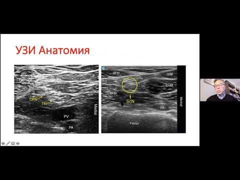 Видео: Блокада седалищного нерва