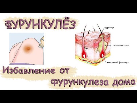 Видео: Фурункулез / Как быстро избавится от фурункулов / Дегтярное мыло