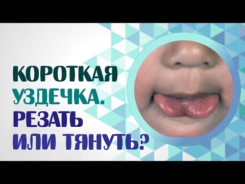 Видео: Короткая уздечка.  Резать Нельзя Тянуть. Где ставить запятую?