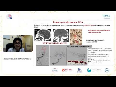 Видео: Реперфузионная терапия при инсульте в системе задней циркуляции д.м.н., проф. Хасанова Д.Р.