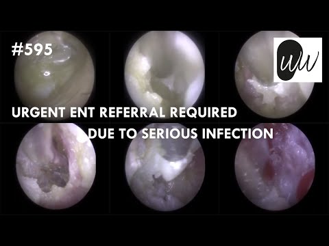 Видео: 595 — Требуется срочное направление к ЛОР-врачу из-за серьёзной ушной инфекции