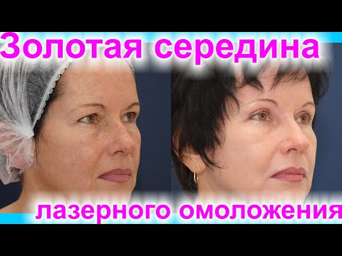 Видео: Лазерная шлифовка лица после 40 лет. Омоложение. Реально ли это? До/После. #1