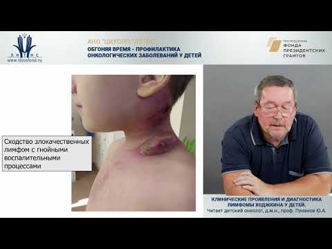 Видео: Клинические проявления и диагностика лимфомы Ходжкина у детей