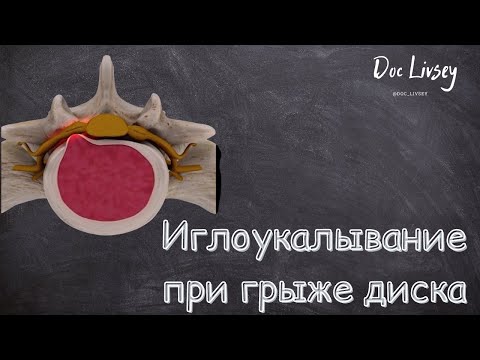 Видео: Иглоукалывание при грыже межпозвонкового диска