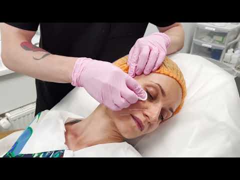 Видео: Хирург Николай Макеенко про Жидкий лифтинг