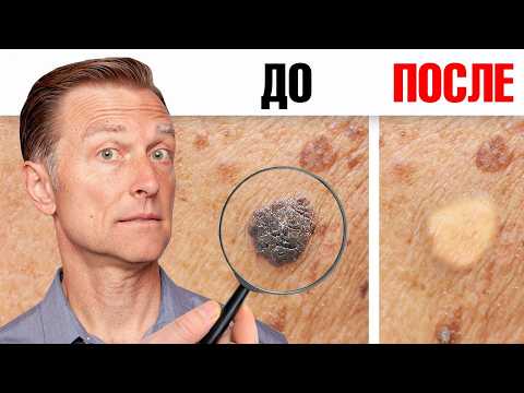Видео: Как избавиться от папиллом и бородавок за ОДНУ ночь?👀