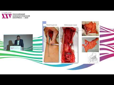 Видео: Реконструкция сложных мягкотканных комбинированных дефектов при раке слизистой оболочки полости рта