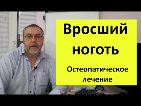 Видео: Вросший ноготь. Почему возникает, и как вылечить быстро, и насовсем.