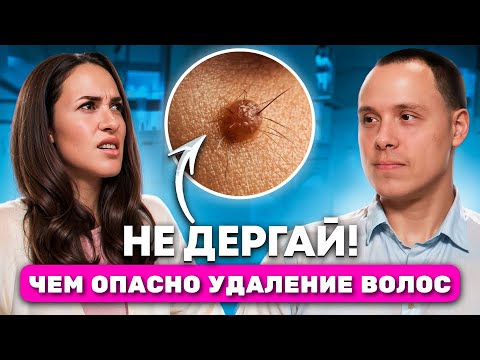 Видео: ДЕРМАТОЛОГ-ОНКОЛОГ про удаление волос ИЗ РОДИНОК, эпиляцию и электроэпиляцию. Возникновение меланомы