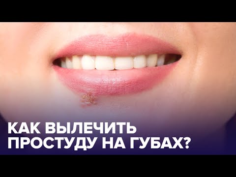 Видео: Как вылечить ПРОСТУДУ НА ГУБАХ? SOS-средства от герпеса