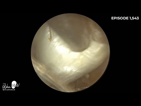 Видео: 1543 - Сложное радикальное удаление омертвевшей кожи из полости сосцевидного отростка