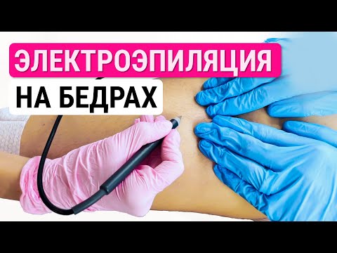 Видео: Урок №53. Электроэпиляция ног | Процесс электроэпиляции