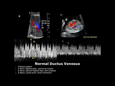 Видео: Допплерография венозного протока плода: нормальные и патологические изображения | Спектральная до...