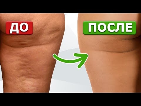 Видео: Целлюлит, ПРОЩАЙ! Три самых простых упражнения от апельсиновой корки🍊