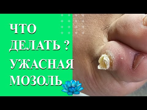 Видео: Стержневая мозоль на пальце. Лечение стержневой мозоли.