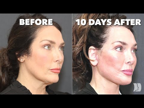 Видео: Я не мог поверить, как быстро она восстановилась – потрясающие результаты и бионическая линия под...