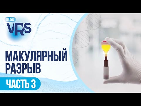 Видео: Макулярный разрыв / часть 3