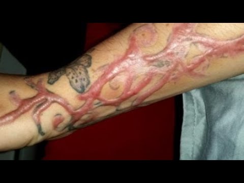 Видео: Келоидные рубцы: новое в лечении