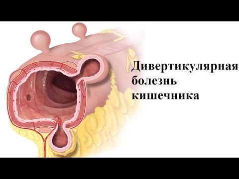 Видео: Дивертикулез и дивертикулит. Всё о дивертикулярной болезни кишечника