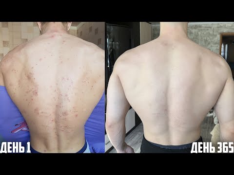 Видео: 365 ДНЕЙ АКНЕКУТАНА или КАК ВЫЛЕЧИТЬ АКНЕ И ИЗБАВИТЬСЯ ОТ ПРЫЩЕЙ? ВОТ ЧТО ВЫШЛО!