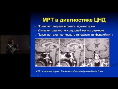 Видео: Несахарный диабет и электролитные нарушения у детей | Мизеркина Н. А.