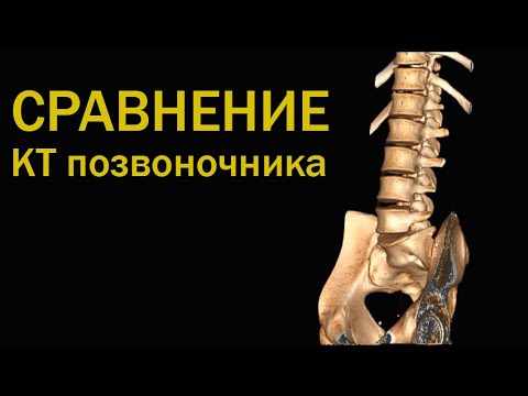 Видео: Зачем делать КТ позвоночника / КТ Епифанова разбор