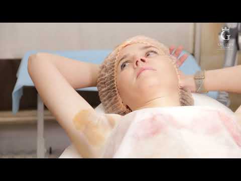 Видео: Гипергидроз или повышенная потливость: 2 недели после процедуры.