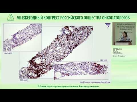 Видео: Побочные эффекты противоопухолевой терапии. Почка как орган-мишень