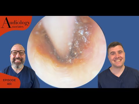 Видео: Глубоко застрявшая ушная сера и ушная сера, прилипшая к барабанной перепонке - EP831