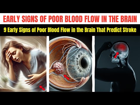 Видео: 9 ранних признаков плохого кровообращения в мозге, которые предсказывают инсульт (которые вы игно...
