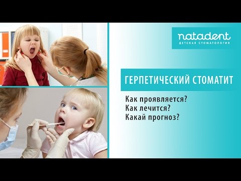 Видео: 30. Острый герпетический стоматит у детей. Как лечить?