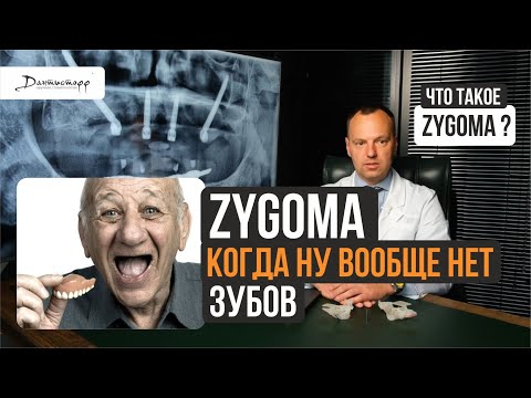 Видео: Скуловая имплантация зубов Zygoma Зигома → при полном отсутствии зубов и костной ткани #zygoma