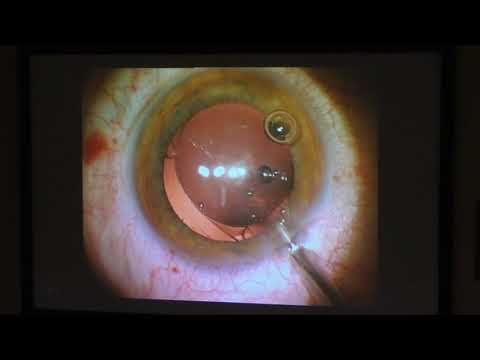 Видео: Инородное тело хрусталика