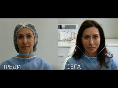 Видео: Фейслифтинг с конци Aptos в Hill clinic