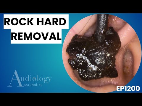 Видео: Экстремальное удаление ушной серы | Глубокое удаление пробок и сухой кожи - MEP1200