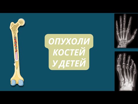 Видео: Опухоли Костей у Детей
