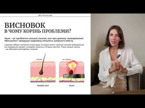 Видео: Акне. Правда, в яку не хочеться вірити, але саме це і є головним секретом виходу в ремісію.
