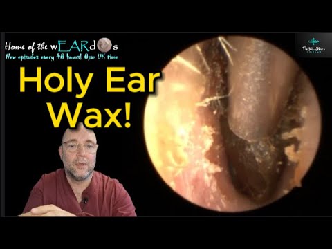 Видео: СВЯТАЯ УШНАЯ СЕРА! 246 #ухо #ушнаясера #удалениеушнойсеры #чисткаушей #клиникаудаленияушнойсеры #...