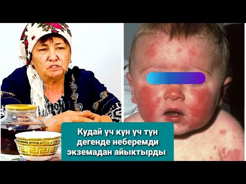 Видео: Орозбакова Кундуз # Кудай үч күн үч түн дегенде неберемди экземадан айыктырды.