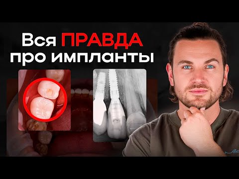 Видео: ЛУЧШИЕ и ХУДШИЕ имплантаты!