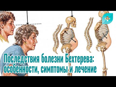 Видео: Последствия болезни Бехтерева: особенности, симптомы и лечение