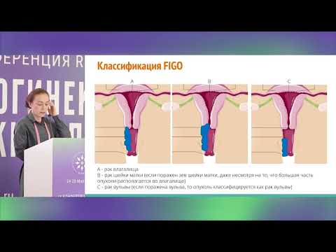Видео: Особенности ЛТ и ХЛТ при различных редких плоскоклеточных раках (рак вульвы, влагалища)