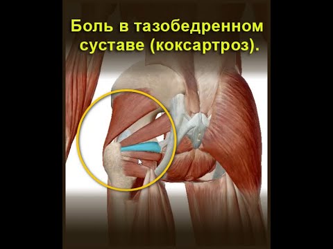 Видео: . Миофасциальный болевой синдром. Боль в тазобедренном суставе (коксартроз).