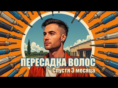 Видео: Пересадка волос спустя 3 месяца / Клиника GG Med