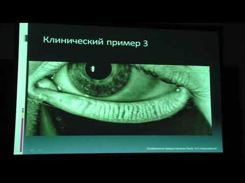 Видео: Жесткая комбинация Глаукома и синдром сухого глаза